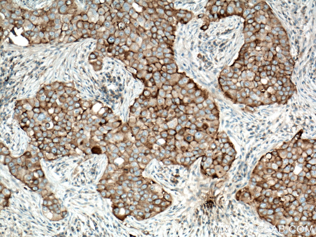 Immunohistochemistry (IHC) staining of human breast cancer tissue using CD71 Monoclonal antibody (66180-1-Ig)