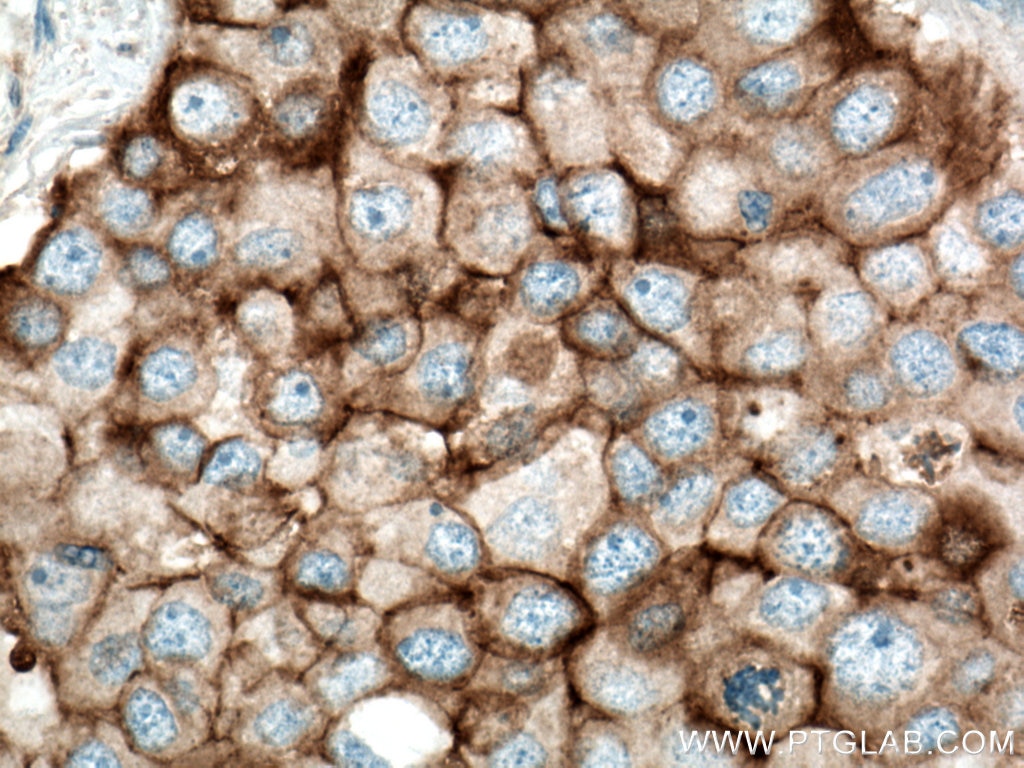 IHC staining of human breast cancer using 66180-1-Ig