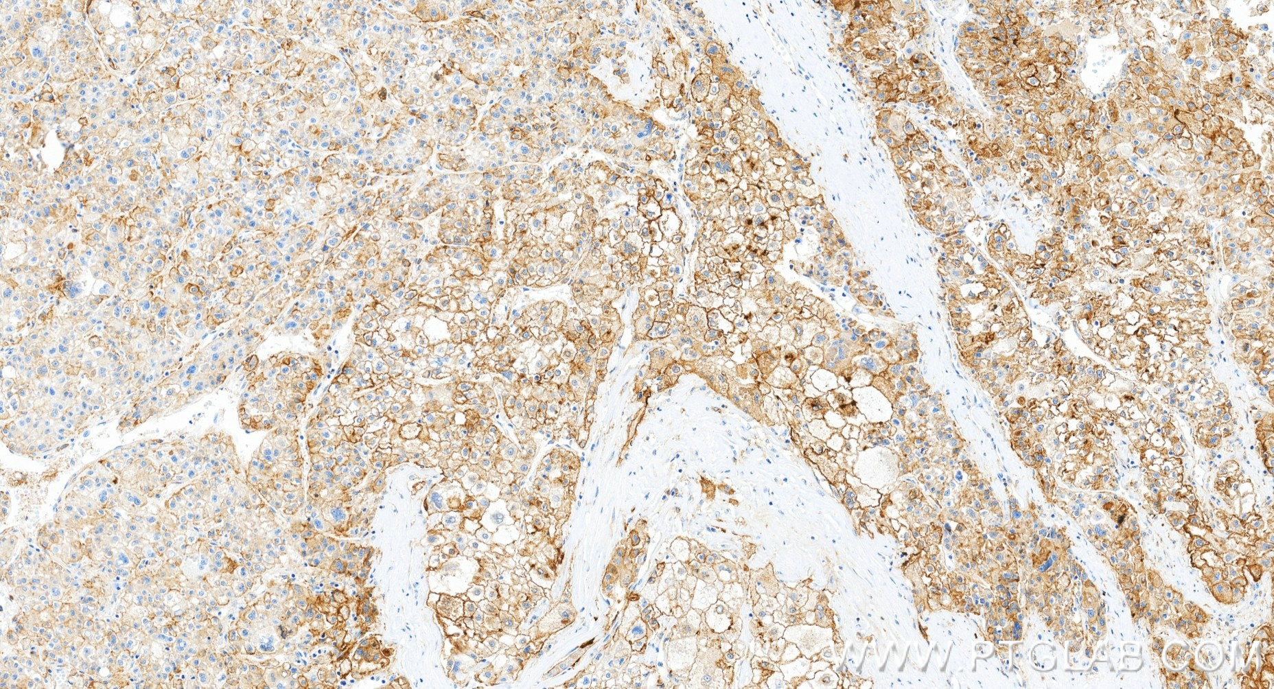 Immunohistochemistry (IHC) staining of human liver cancer tissue using CD71 Recombinant monoclonal antibody (81793-13-RR)