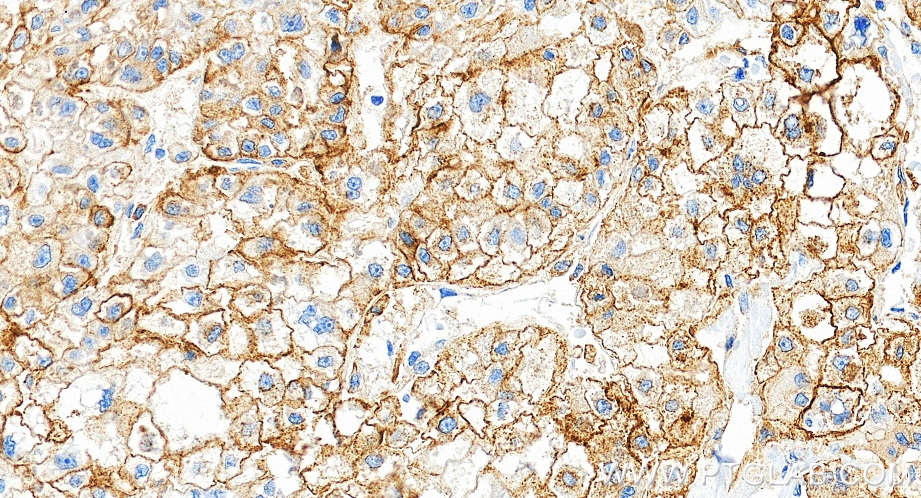 Immunohistochemistry (IHC) staining of human liver cancer tissue using CD71 Recombinant monoclonal antibody (81793-13-RR)