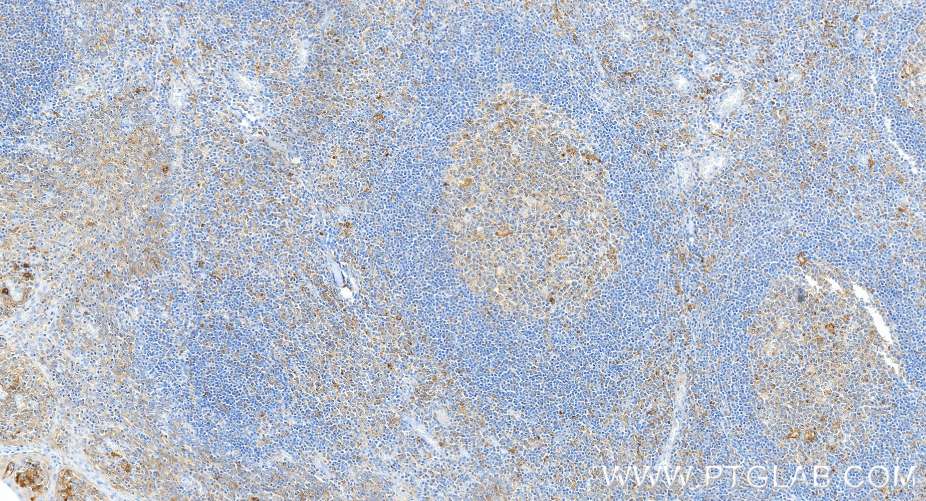 Immunohistochemistry (IHC) staining of human tonsillitis tissue using CD71 Recombinant monoclonal antibody (81793-13-RR)
