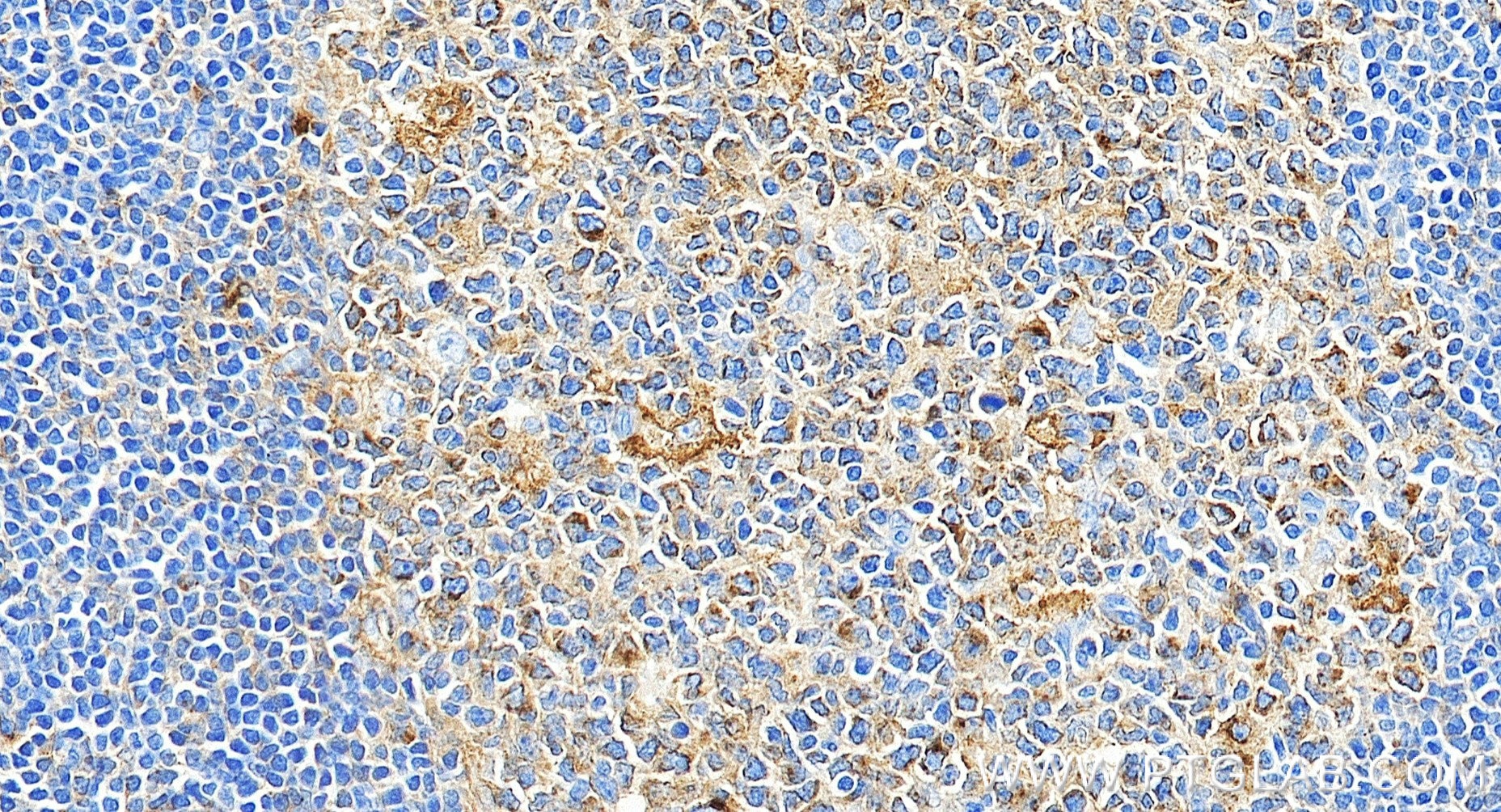 Immunohistochemistry (IHC) staining of human tonsillitis tissue using CD71 Recombinant monoclonal antibody (81793-13-RR)
