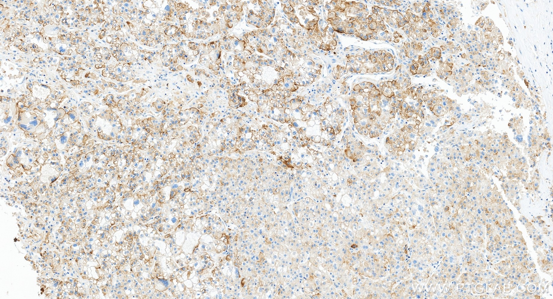 IHC staining of human liver cancer using 81793-14-RR Immunohistochemistry (IHC) staining of human liver cancer tissue using CD71 Recombinant monoclonal antibody (81793-14-RR)