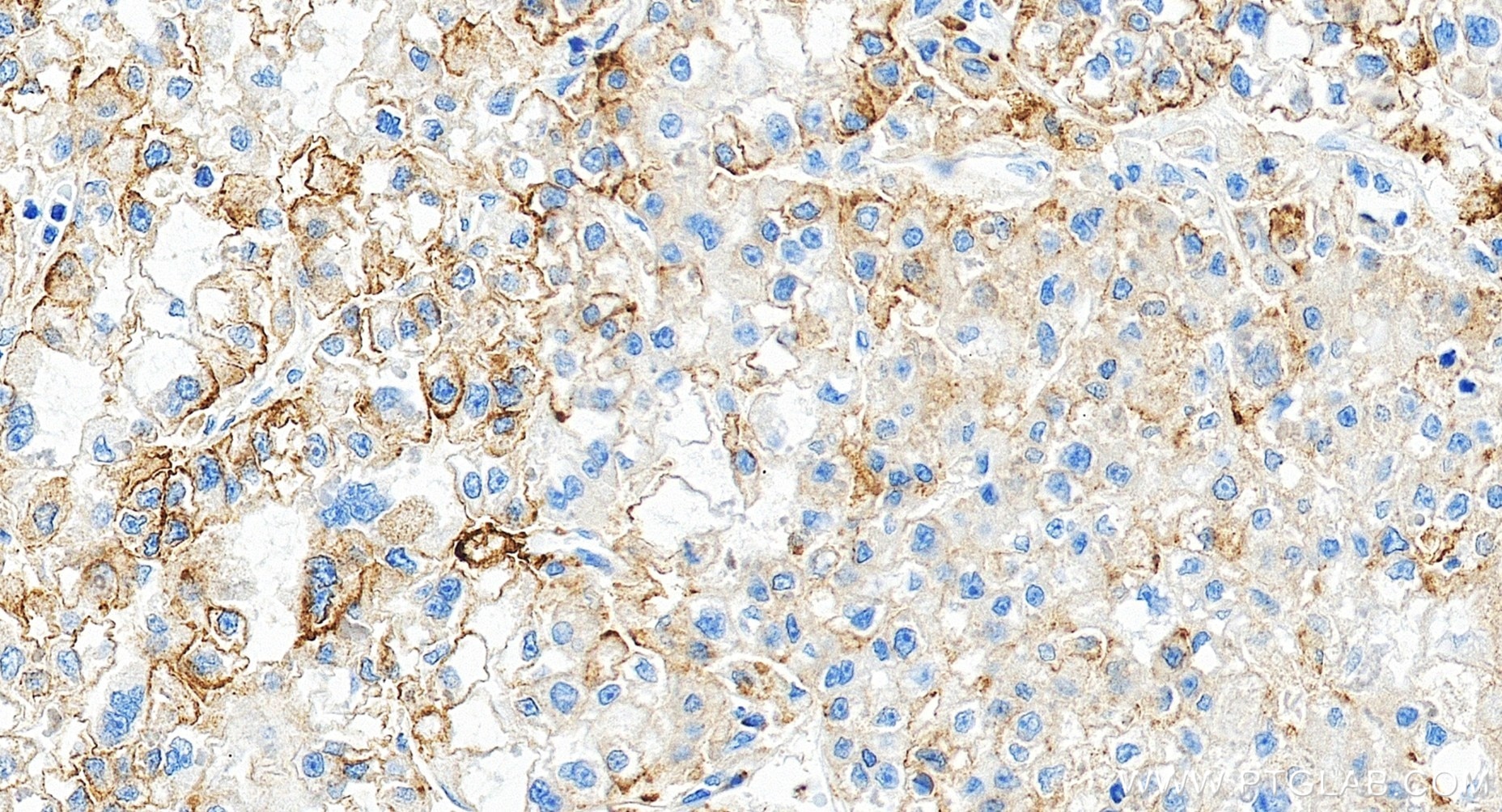 IHC staining of human liver cancer using 81793-14-RR Immunohistochemistry (IHC) staining of human liver cancer tissue using CD71 Recombinant monoclonal antibody (81793-14-RR)