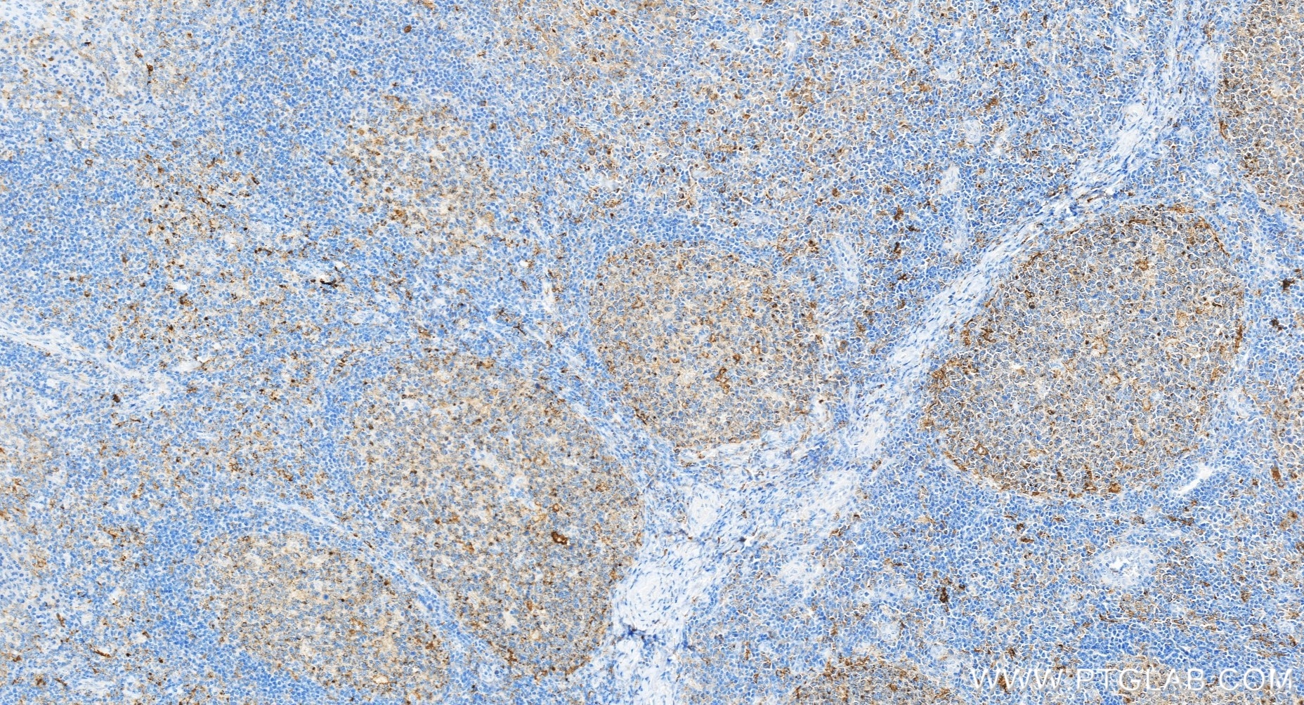 IHC staining of human tonsillitis using 81793-14-RR Immunohistochemistry (IHC) staining of human tonsillitis tissue using CD71 Recombinant monoclonal antibody (81793-14-RR)