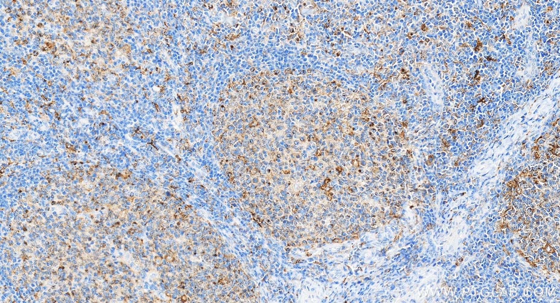 IHC staining of human tonsillitis using 81793-14-RR Immunohistochemistry (IHC) staining of human tonsillitis tissue using CD71 Recombinant monoclonal antibody (81793-14-RR)