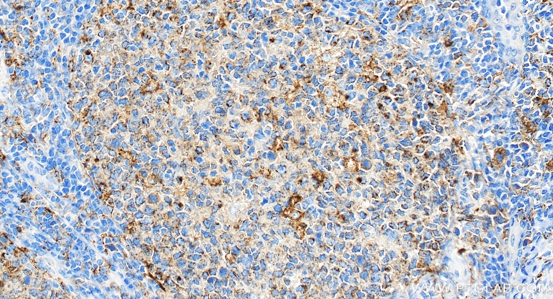 IHC staining of human tonsillitis using 81793-14-RR Immunohistochemistry (IHC) staining of human tonsillitis tissue using CD71 Recombinant monoclonal antibody (81793-14-RR)