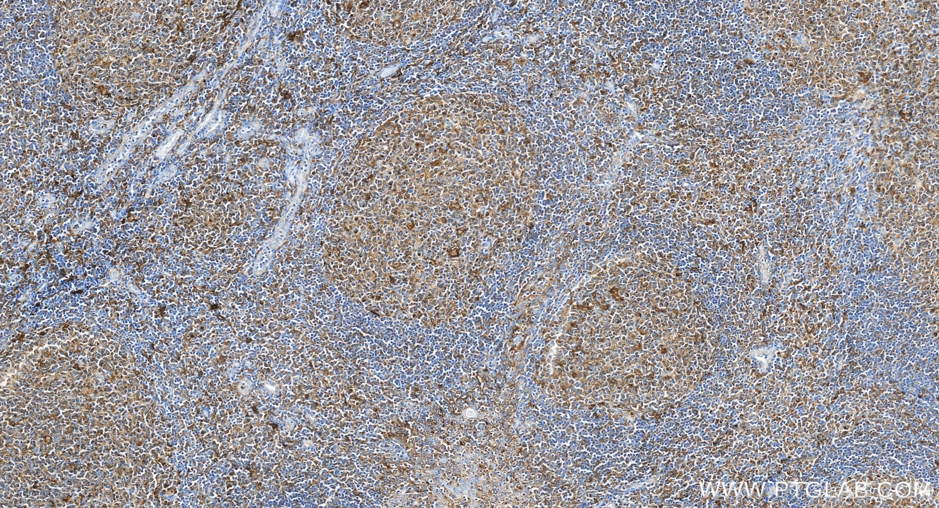 Immunohistochemistry (IHC) staining of human tonsillitis tissue using CD71 Recombinant monoclonal antibody (81793-3-RR)