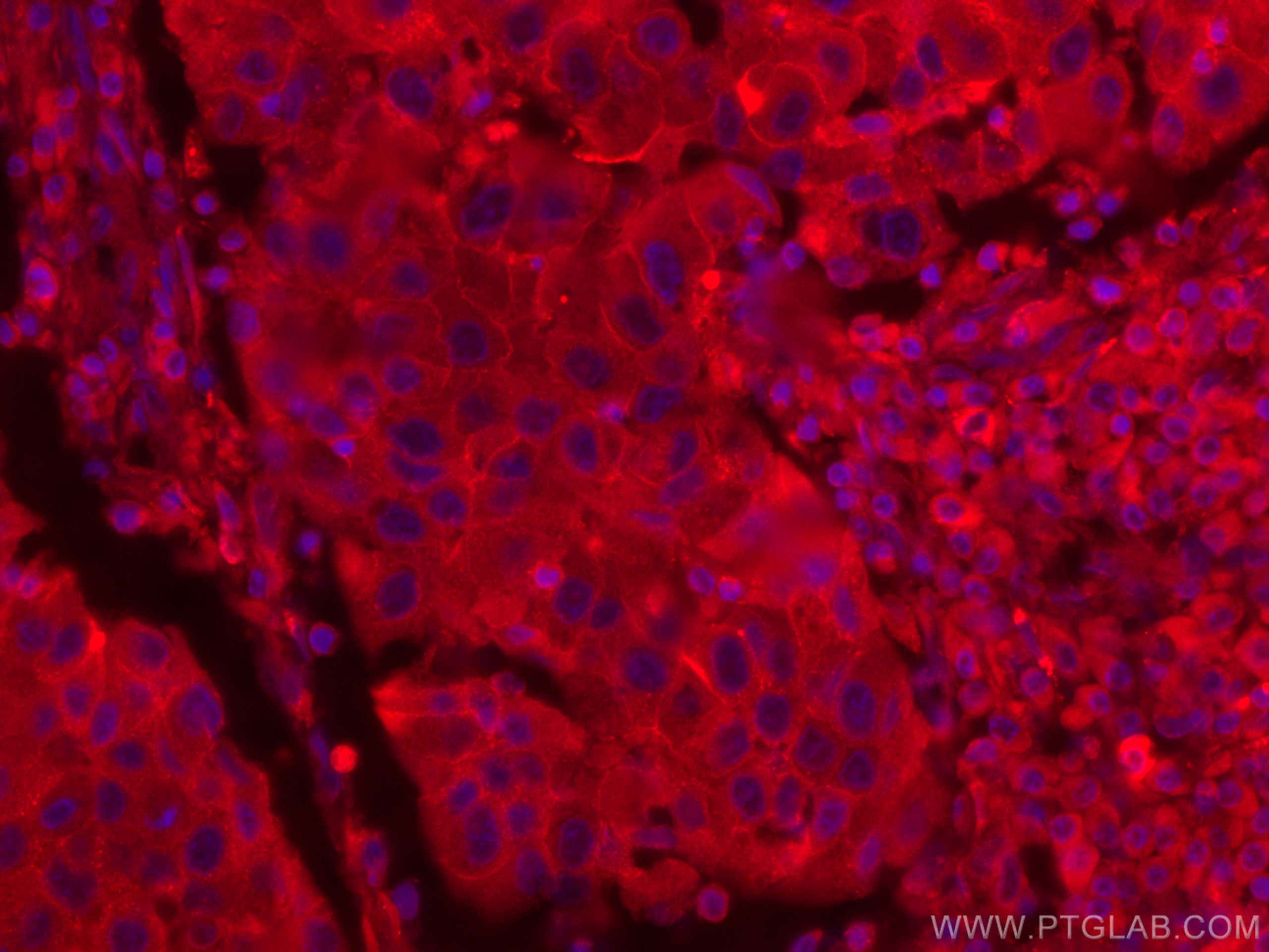 Immunofluorescence (IF) / fluorescent staining of human breast cancer tissue using CoraLite®594-conjugated CD71 Monoclonal antibody (CL594-66180)