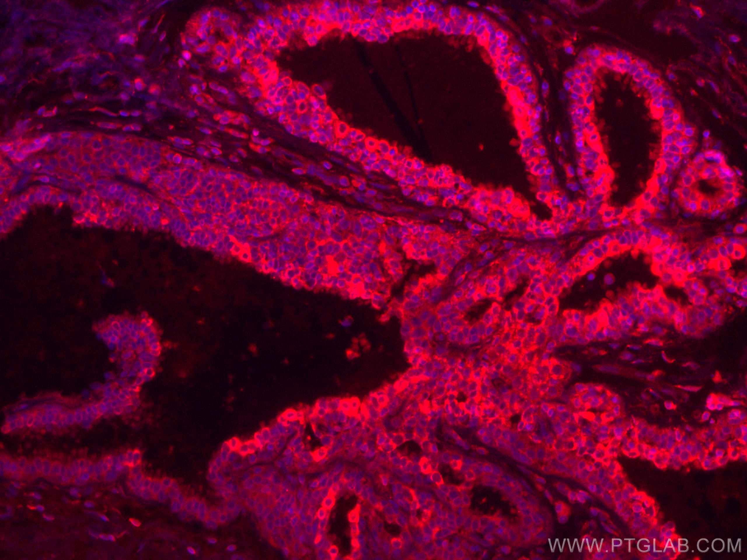 Immunofluorescence (IF) / fluorescent staining of human breast cancer tissue using CoraLite®594-conjugated CD71 Monoclonal antibody (CL594-66180)