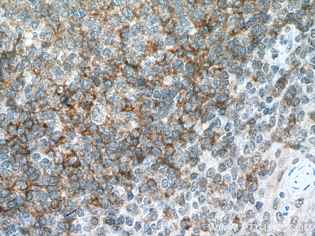 Immunohistochemistry (IHC) staining of human tonsillitis tissue using CD72 Monoclonal antibody (67424-1-Ig)