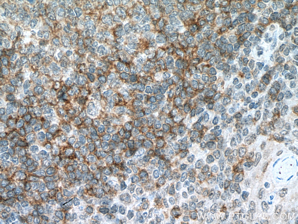 IHC staining of human tonsillitis using 67424-1-Ig