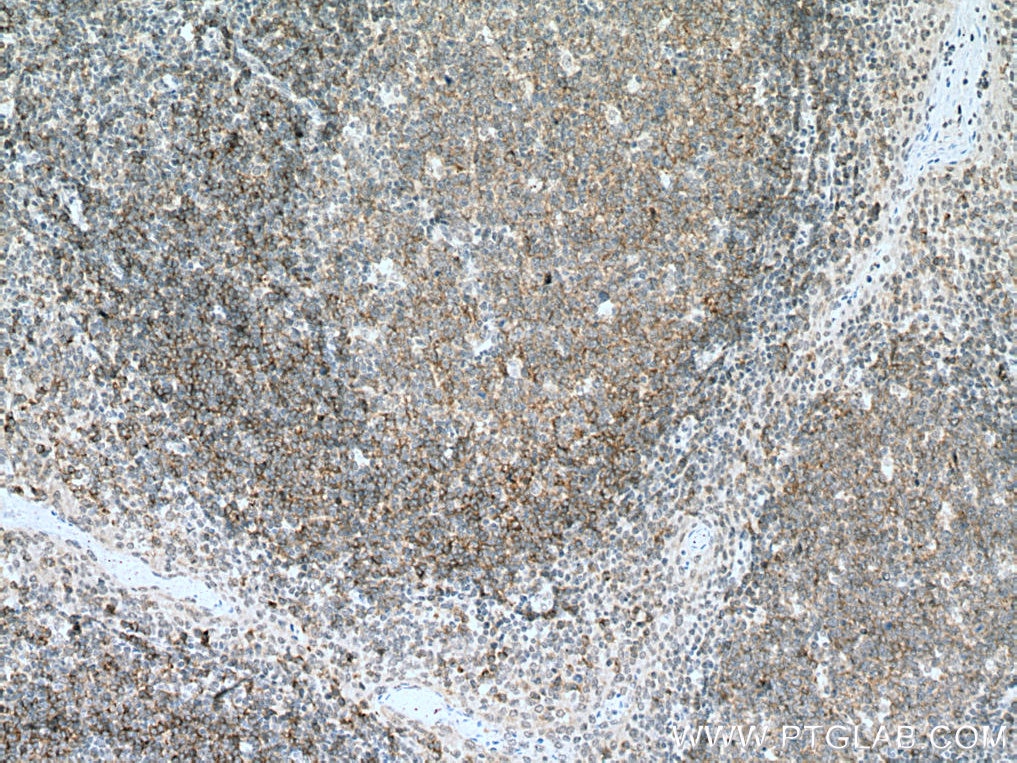 Immunohistochemistry (IHC) staining of human tonsillitis tissue using CD72 Monoclonal antibody (67424-1-Ig)