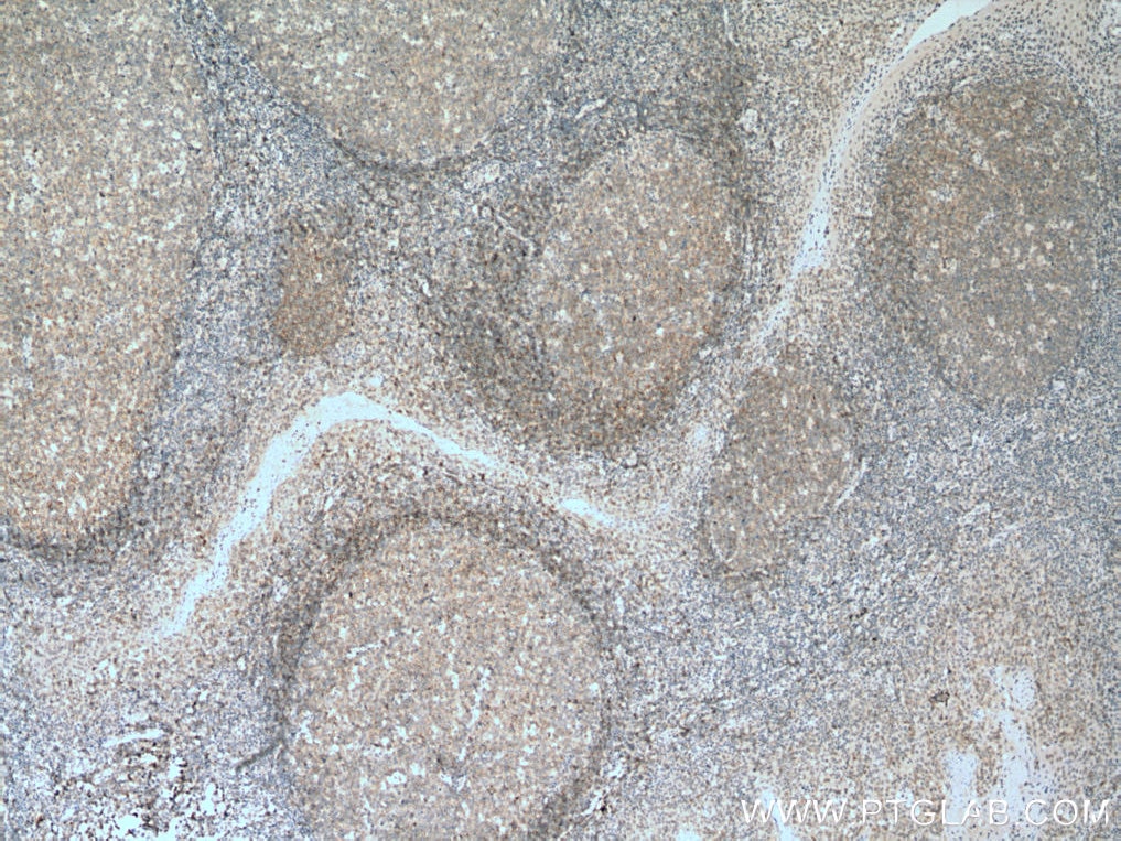 IHC staining of human tonsillitis using 67424-1-Ig