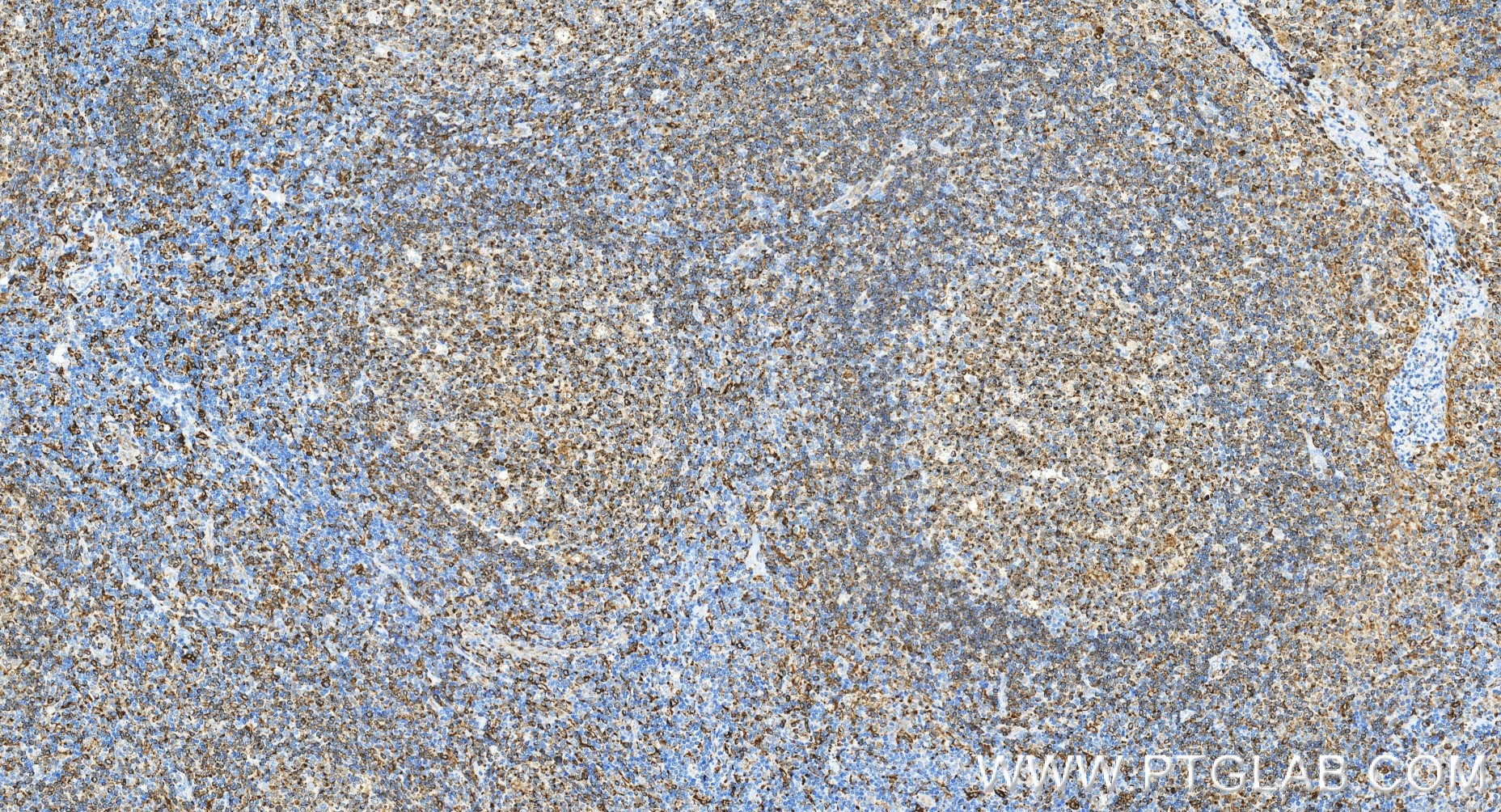 IHC staining of human tonsillitis using 98478-2-RR Immunohistochemistry (IHC) staining of human tonsillitis tissue using Anti-Human CD74 Rabbit Recombinant Antibody (98478-2-RR)