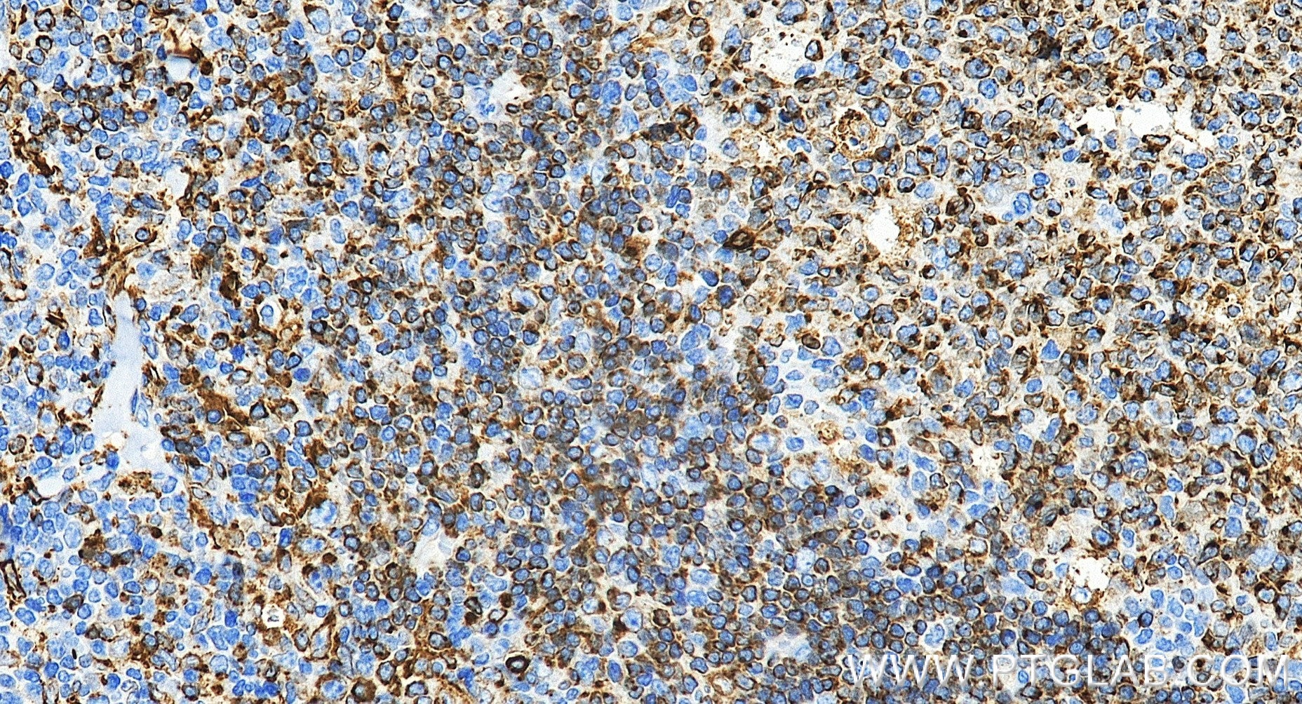 IHC staining of human tonsillitis using 98478-2-RR Immunohistochemistry (IHC) staining of human tonsillitis tissue using Anti-Human CD74 Rabbit Recombinant Antibody (98478-2-RR)