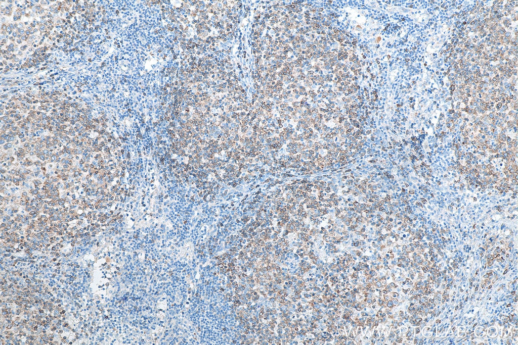 Immunohistochemistry (IHC) staining of human lymphoma tissue using CD79A Polyclonal antibody (22349-1-AP)