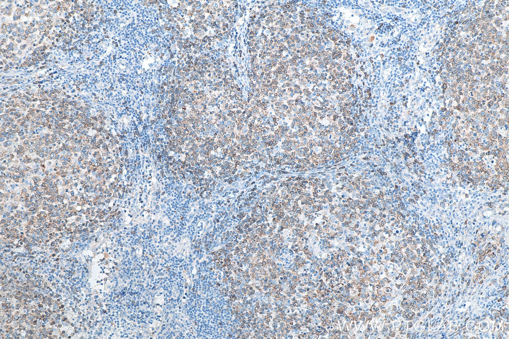 IHC staining of human lymphoma using 22349-1-AP