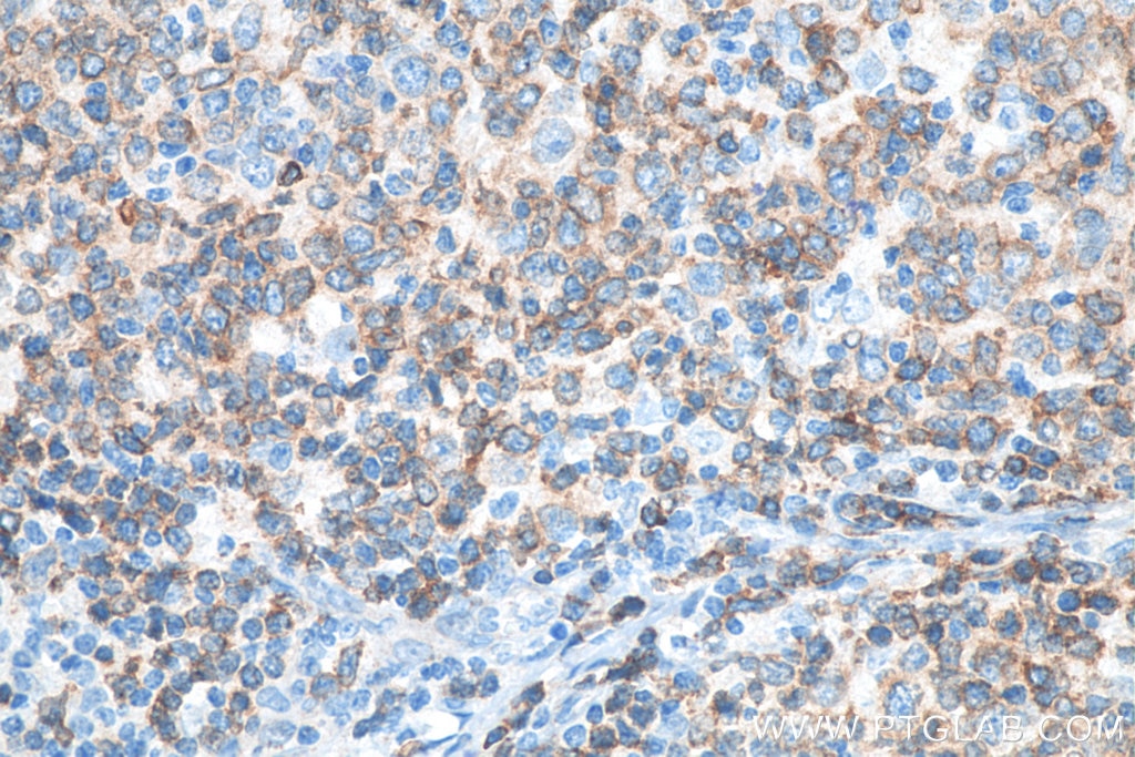 Immunohistochemistry (IHC) staining of human lymphoma tissue using CD79A Polyclonal antibody (22349-1-AP)