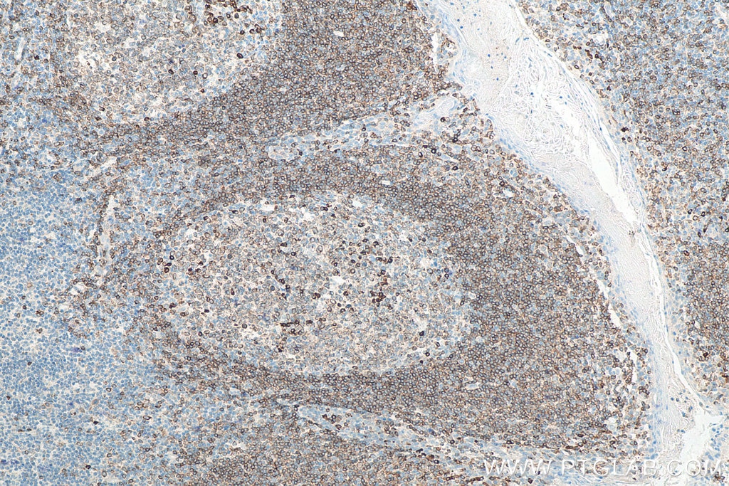 Immunohistochemistry (IHC) staining of human tonsillitis tissue using CD79A Polyclonal antibody (22349-1-AP)