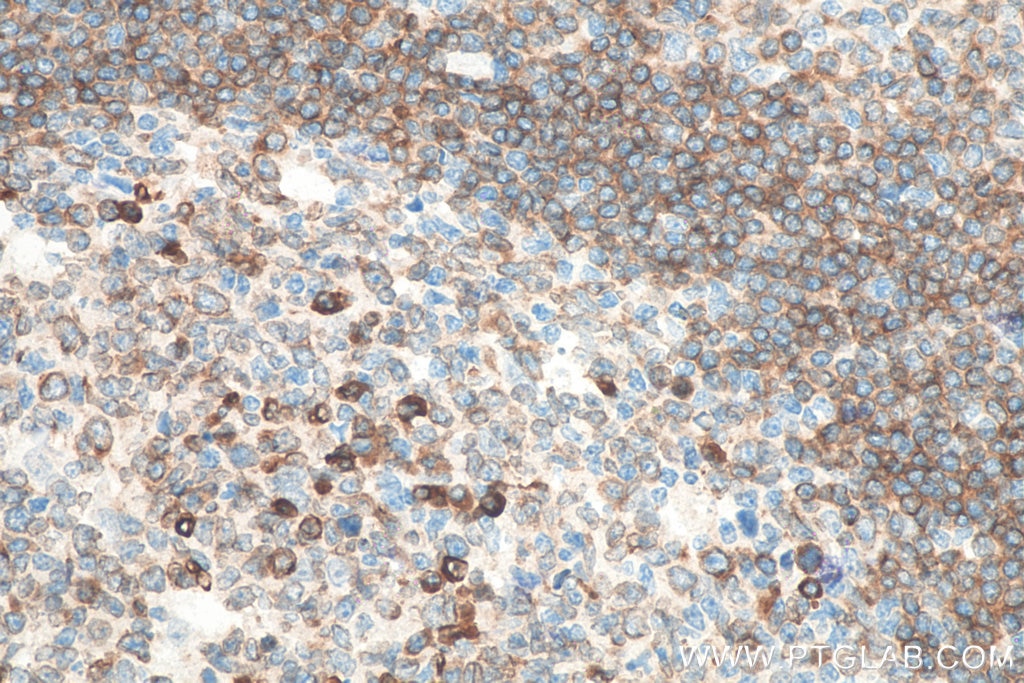 Immunohistochemistry (IHC) staining of human tonsillitis tissue using CD79A Polyclonal antibody (22349-1-AP)