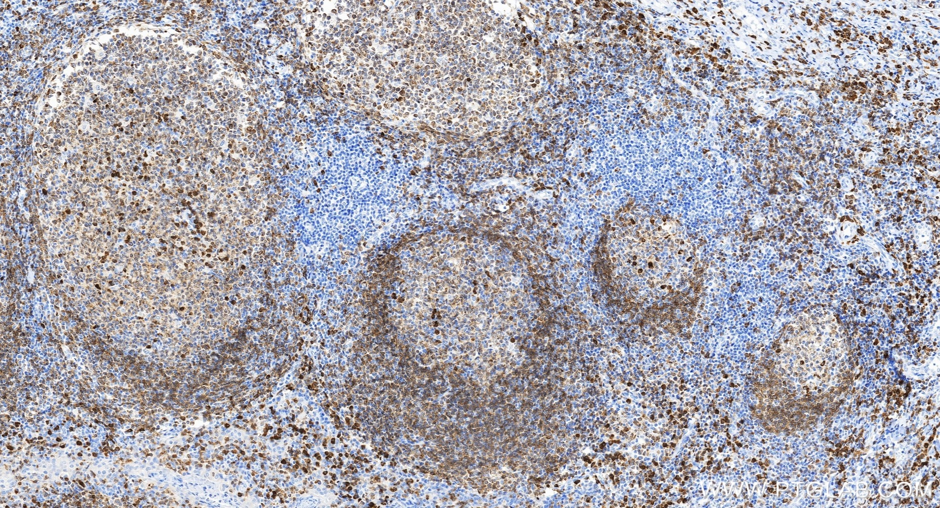 Immunohistochemistry (IHC) staining of human tonsillitis tissue using CD79a Recombinant monoclonal antibody (82747-6-RR)