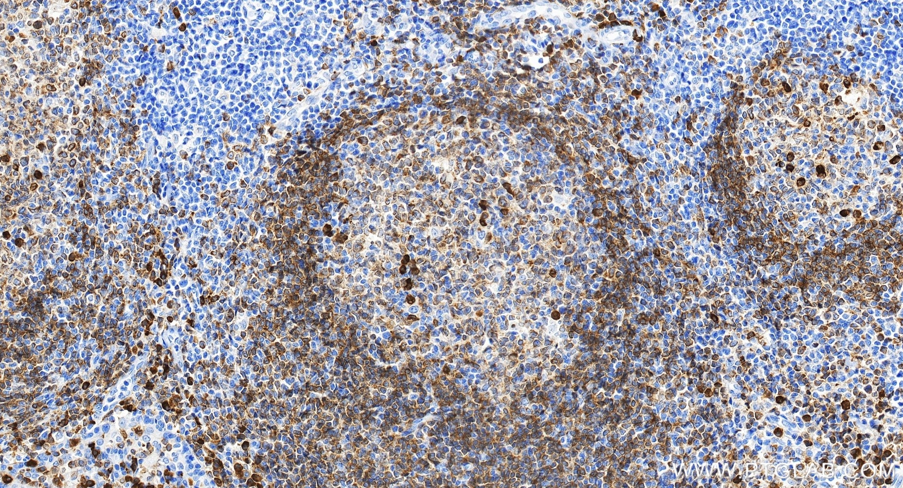 Immunohistochemistry (IHC) staining of human tonsillitis tissue using CD79a Recombinant monoclonal antibody (82747-6-RR)