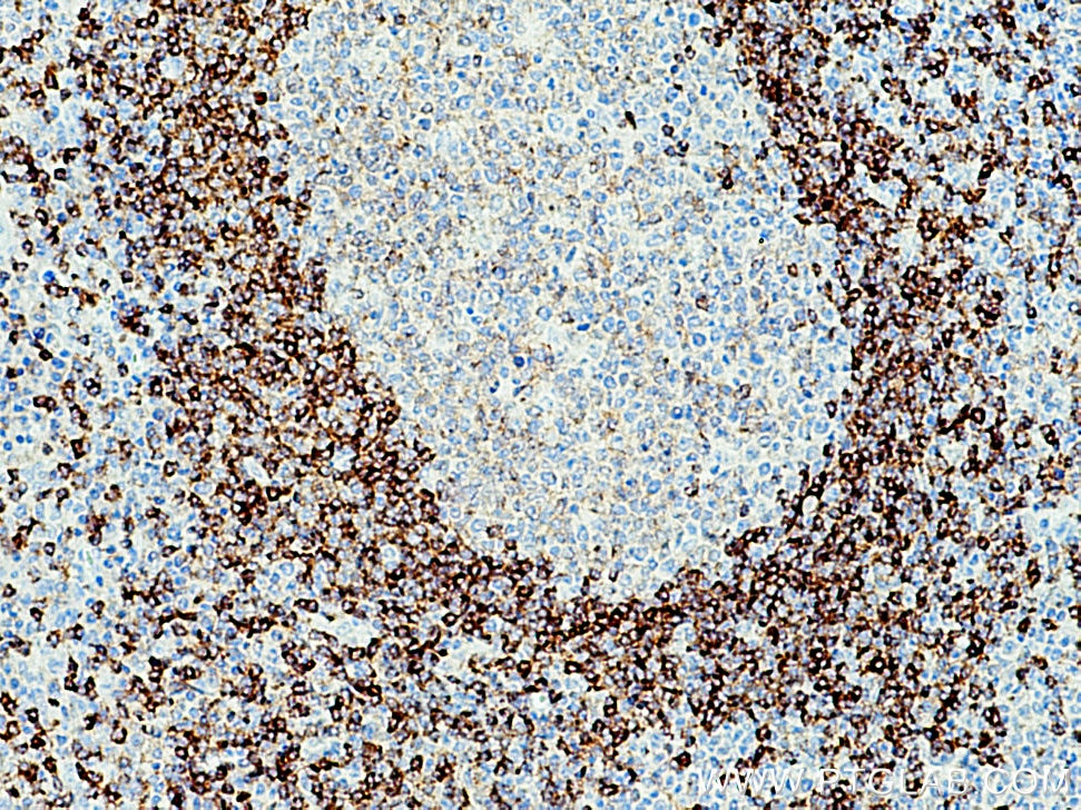 Immunohistochemistry (IHC) staining of human tonsillitis tissue using CD79B Polyclonal antibody (21063-1-AP)