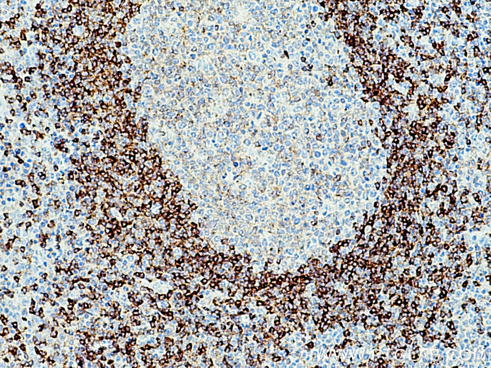 Immunohistochemistry (IHC) staining of human tonsillitis tissue using CD79b Polyclonal antibody (21063-1-AP)
