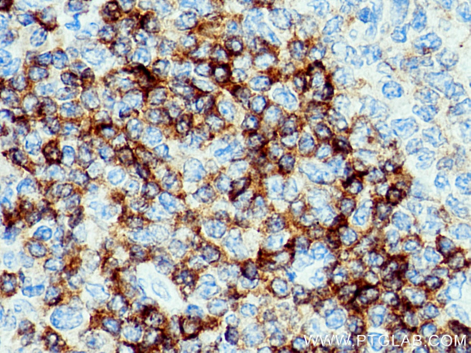 Immunohistochemistry (IHC) staining of human tonsillitis tissue using CD79b Polyclonal antibody (21063-1-AP)