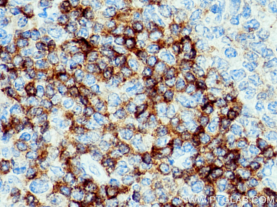 Immunohistochemistry (IHC) staining of human tonsillitis tissue using CD79B Polyclonal antibody (21063-1-AP)