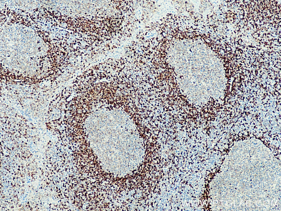 Immunohistochemistry (IHC) staining of human tonsillitis tissue using CD79b Polyclonal antibody (21063-1-AP)