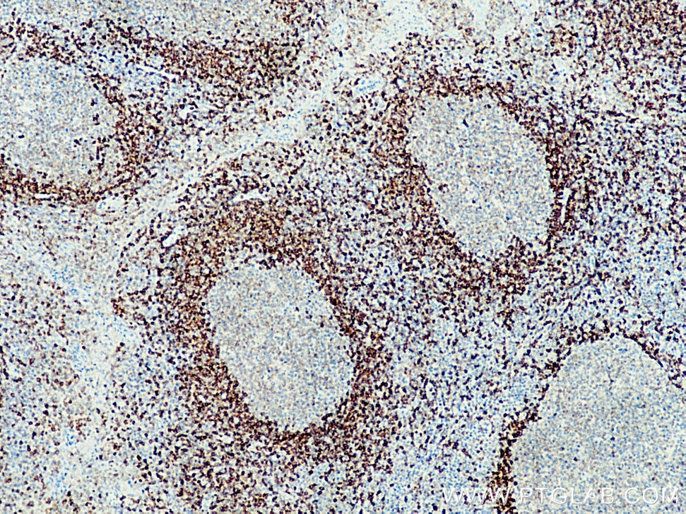 IHC staining of human tonsillitis using 21063-1-AP