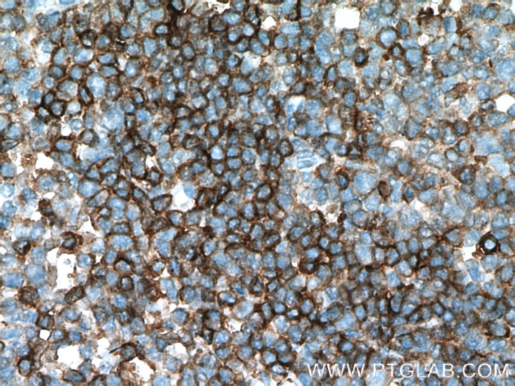 Immunohistochemistry (IHC) staining of human tonsillitis tissue using CD79B Polyclonal antibody (21063-1-AP)