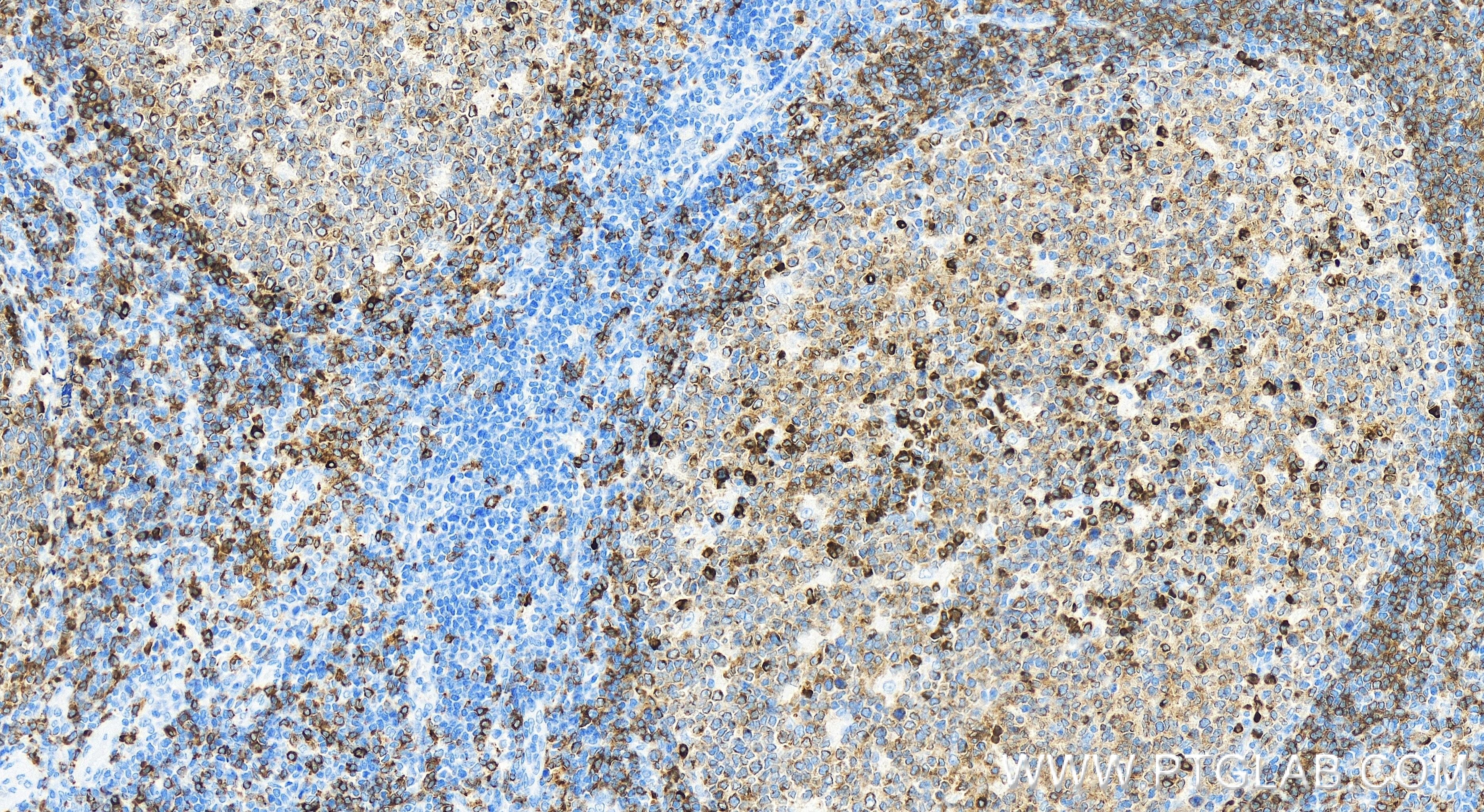 Immunohistochemistry (IHC) staining of human tonsillitis tissue using CD79a Recombinant antibody (84236-4-RR)