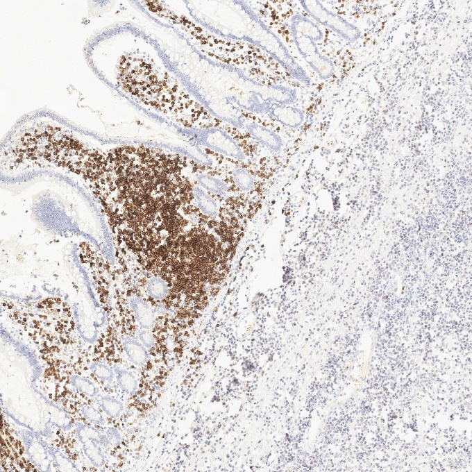 IHC staining of human lymphoma using 84236-4-RR Immunohistochemistry (IHC) staining of human lymphoma tissue using CD79a Recombinant monoclonal antibody (84236-4-RR)