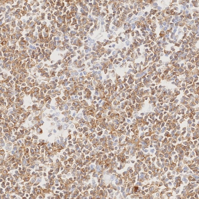 IHC staining of human lymphoma using 84236-4-RR Immunohistochemistry (IHC) staining of human lymphoma tissue using CD79a Recombinant monoclonal antibody (84236-4-RR)