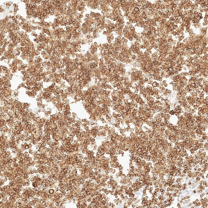 IHC staining of human lymphoma using 84236-4-RR Immunohistochemistry (IHC) staining of human lymphoma tissue using CD79a Recombinant monoclonal antibody (84236-4-RR)