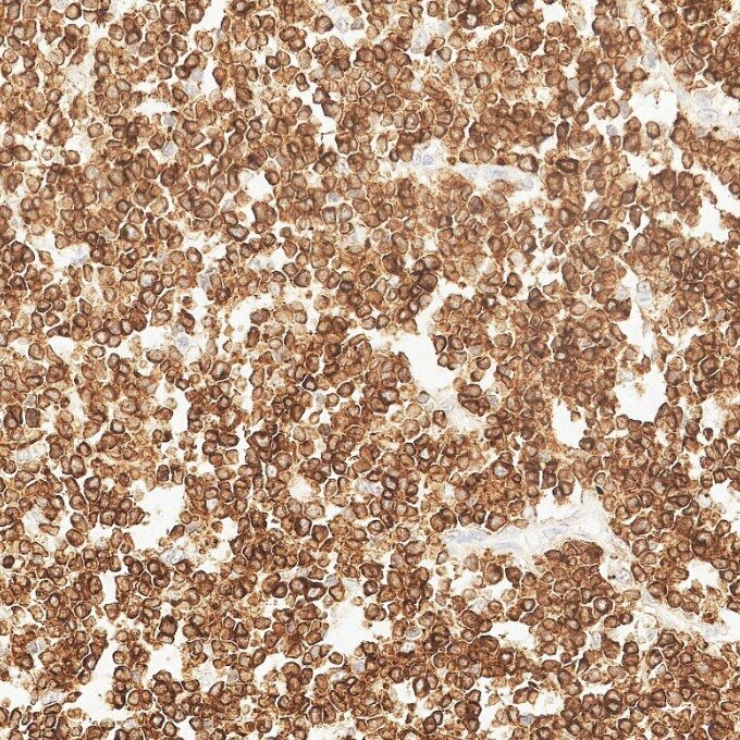 IHC staining of human lymphoma using 84236-4-RR Immunohistochemistry (IHC) staining of human lymphoma tissue using CD79a Recombinant monoclonal antibody (84236-4-RR)