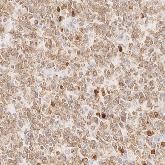 IHC staining of human lymphoma using 84236-4-RR Immunohistochemistry (IHC) staining of human lymphoma tissue using CD79a Recombinant monoclonal antibody (84236-4-RR)