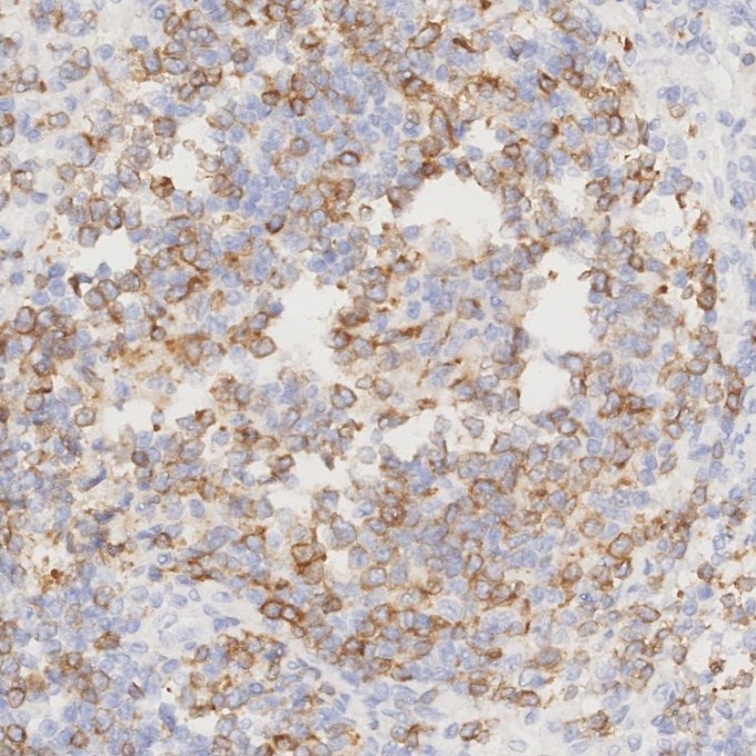 IHC staining of human lymphoma using 84236-4-RR Immunohistochemistry (IHC) staining of human lymphoma tissue using CD79a Recombinant monoclonal antibody (84236-4-RR)