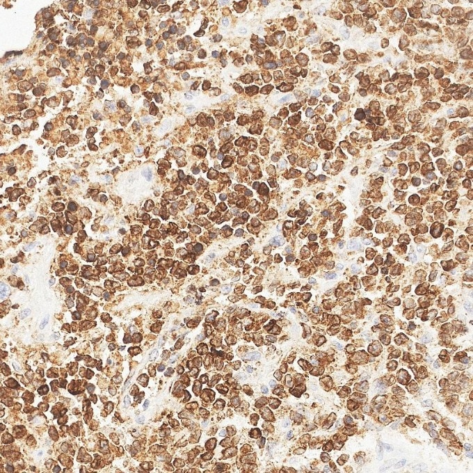 IHC staining of human lymphoma using 84236-4-RR Immunohistochemistry (IHC) staining of human lymphoma tissue using CD79a Recombinant monoclonal antibody (84236-4-RR)