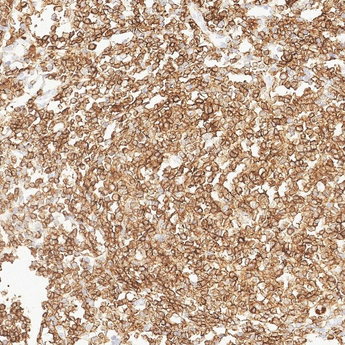 IHC staining of human lymphoma using 84236-4-RR Immunohistochemistry (IHC) staining of human lymphoma tissue using CD79a Recombinant monoclonal antibody (84236-4-RR)