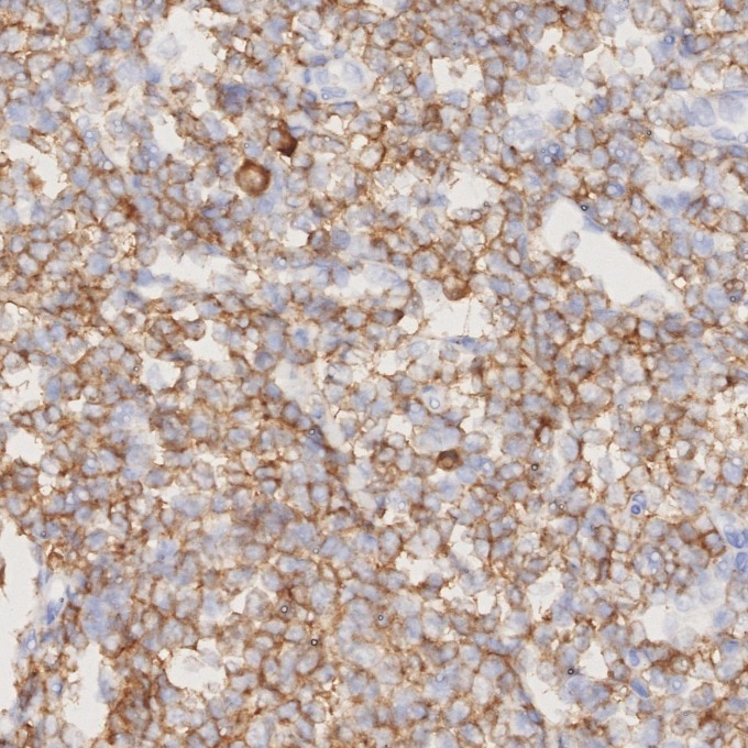 IHC staining of human lymphoma using 84236-4-RR Immunohistochemistry (IHC) staining of human lymphoma tissue using CD79a Recombinant monoclonal antibody (84236-4-RR)
