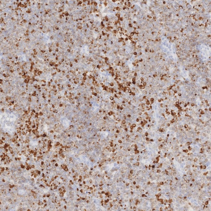 IHC staining of human lymphoma using 84236-4-RR Immunohistochemistry (IHC) staining of human lymphoma tissue using CD79a Recombinant monoclonal antibody (84236-4-RR)
