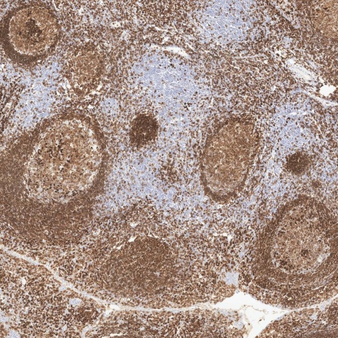 IHC staining of human tonsillitis using 84236-4-RR Immunohistochemistry (IHC) staining of human tonsillitis tissue using CD79a Recombinant monoclonal antibody (84236-4-RR)
