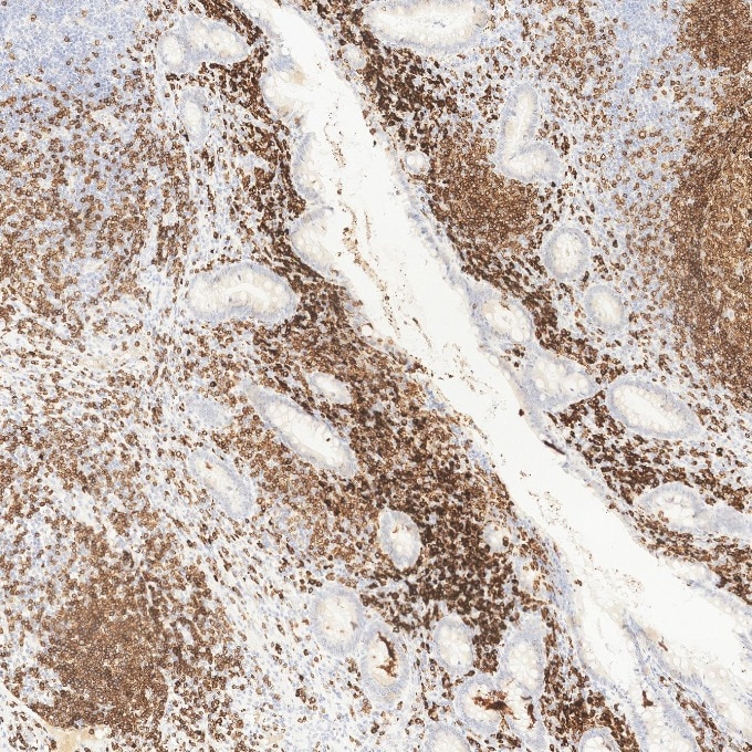 IHC staining of human appendicitis using 84236-4-RR Immunohistochemistry (IHC) staining of human appendicitis tissue using CD79a Recombinant monoclonal antibody (84236-4-RR)