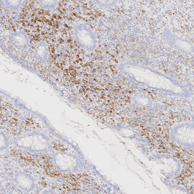 IHC staining of human appendicitis using 84236-4-RR Immunohistochemistry (IHC) staining of human appendicitis tissue using CD79a Recombinant monoclonal antibody (84236-4-RR)