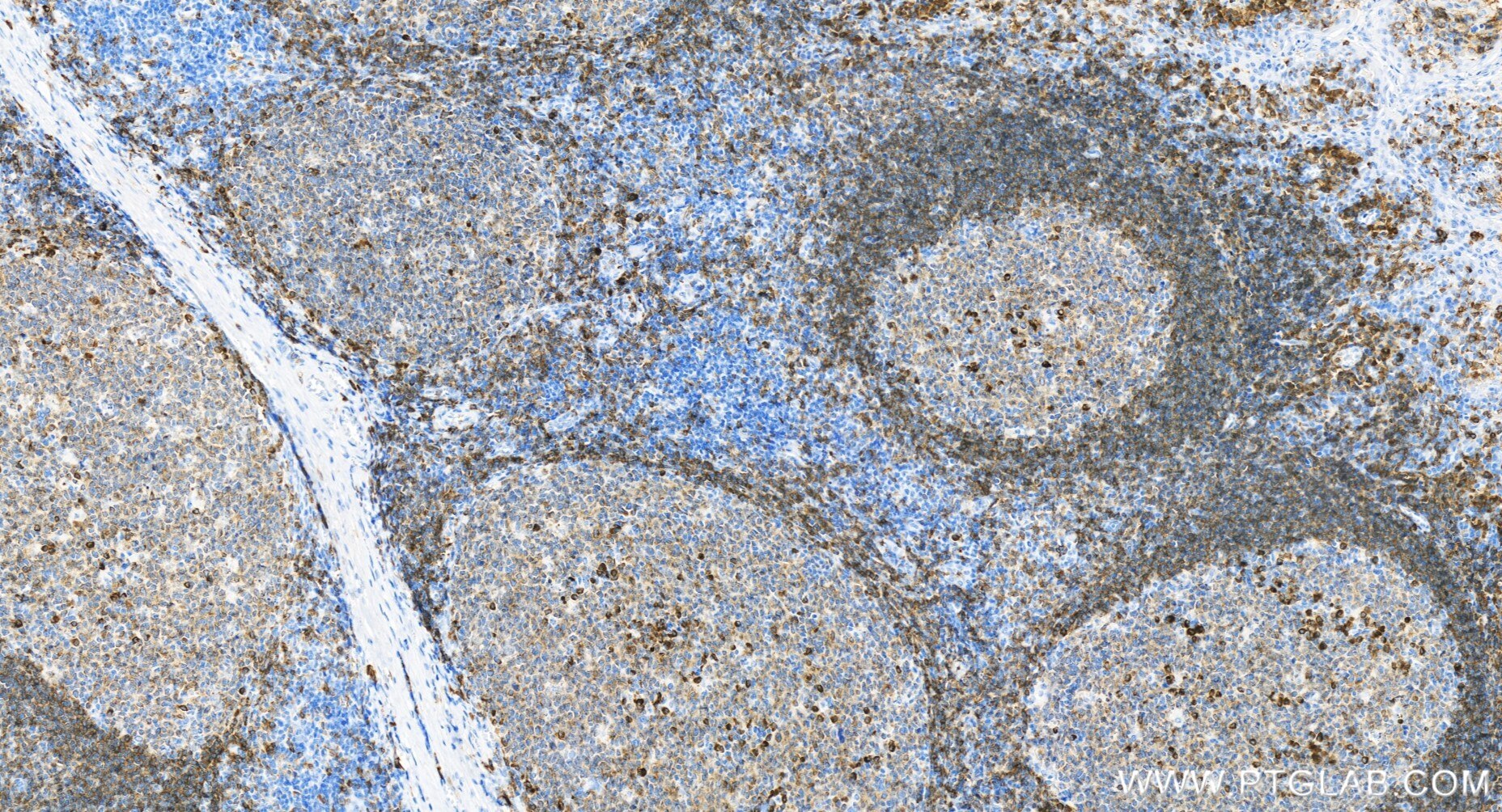 Immunohistochemistry (IHC) staining of human tonsillitis tissue using CD79a Recombinant antibody (84236-5-RR)