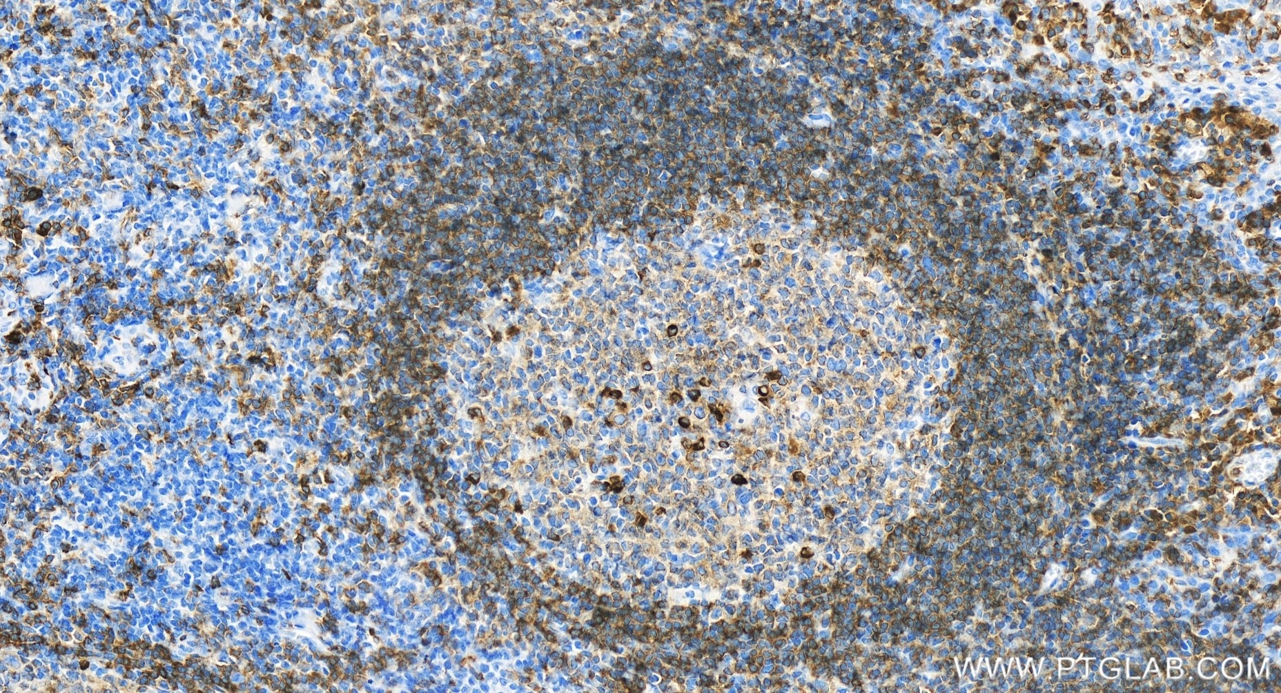 Immunohistochemistry (IHC) staining of human tonsillitis tissue using CD79a Recombinant antibody (84236-5-RR)